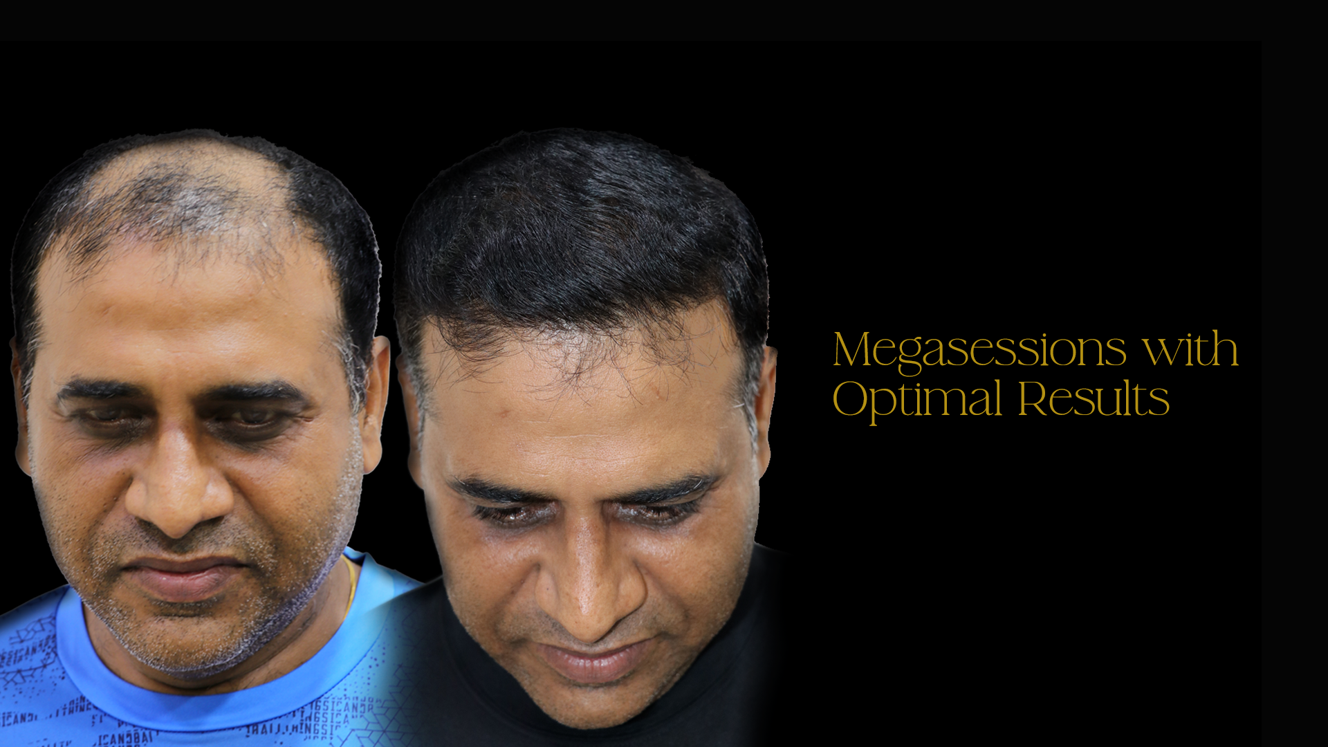 Hair Transplant Cost in Bangalore 2