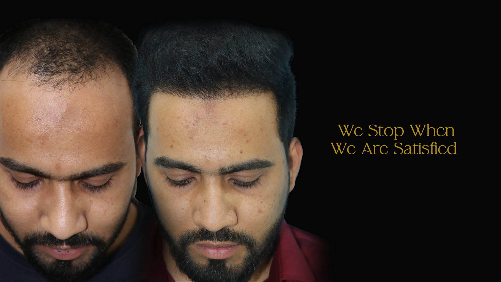 Hair Transplant Cost in Bangalore 4