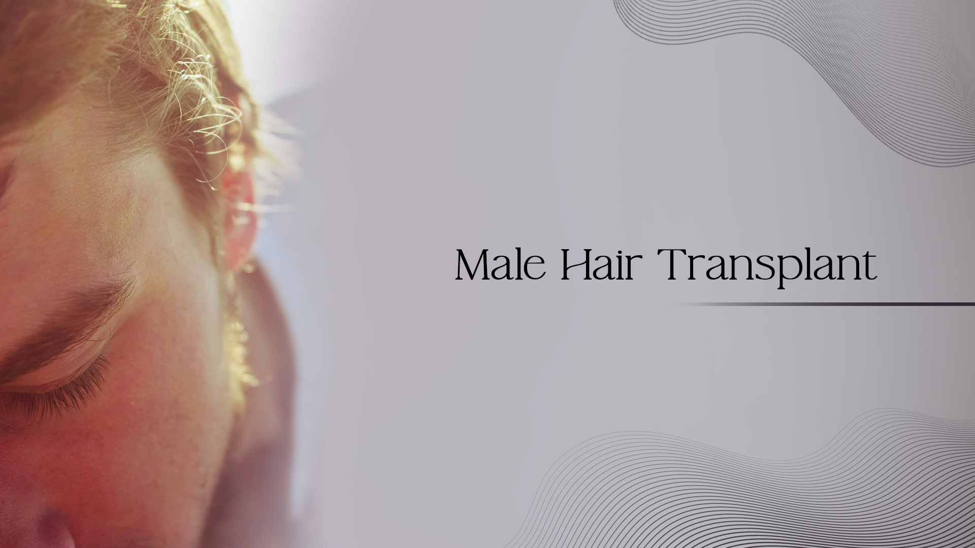 Male Hair Transplant