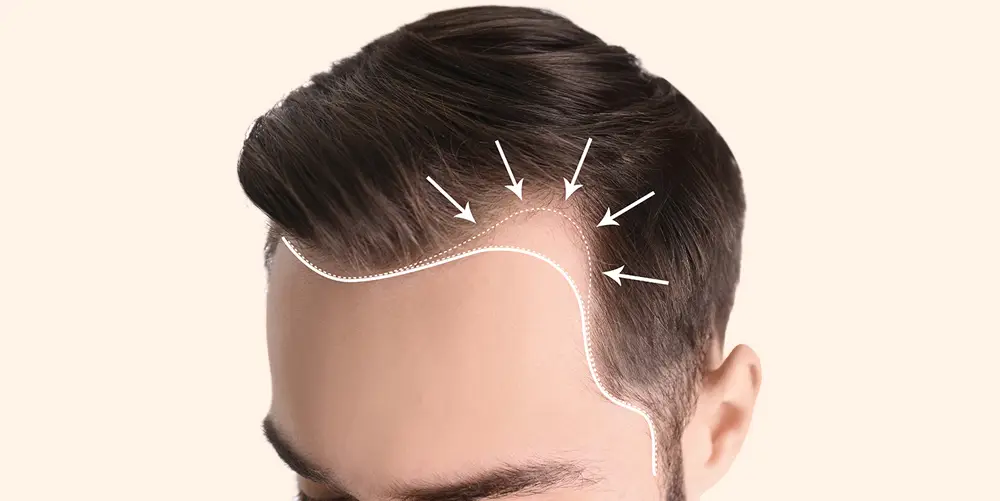 Hair transplant consultation