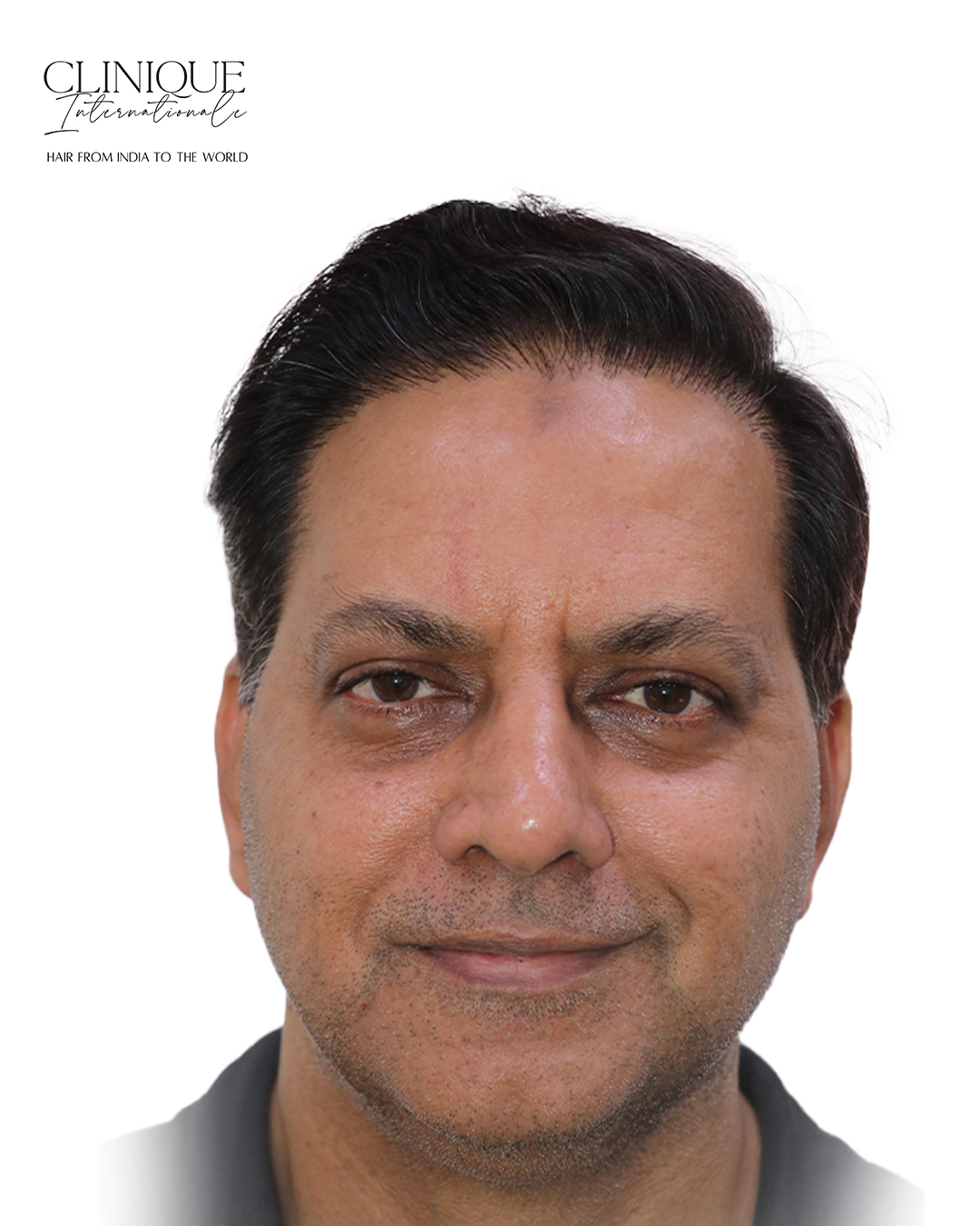 Patient after hair transplant