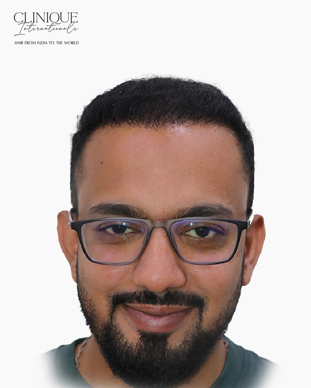 Patient after hair transplant