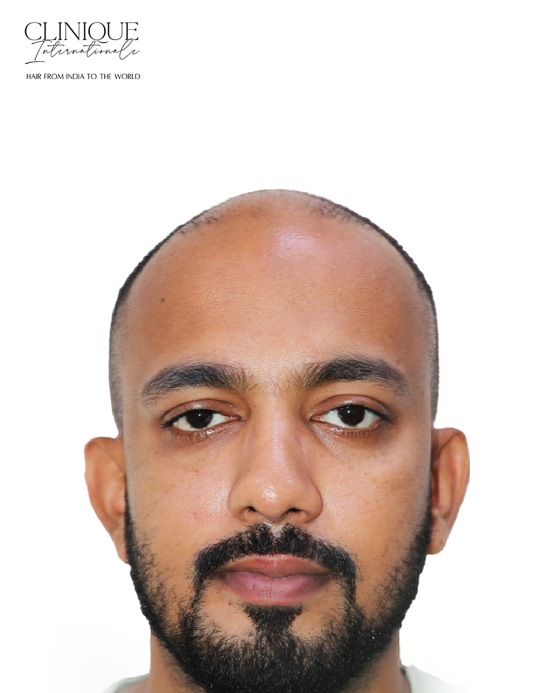 Patient before hair transplant
