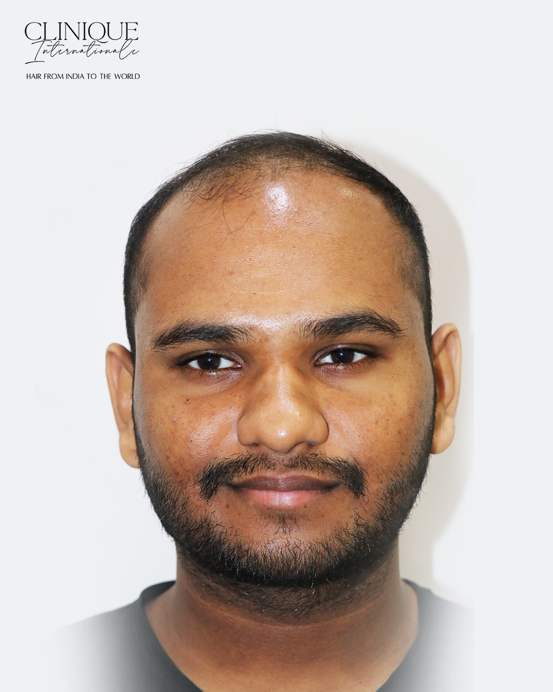 Azad before hair transplant