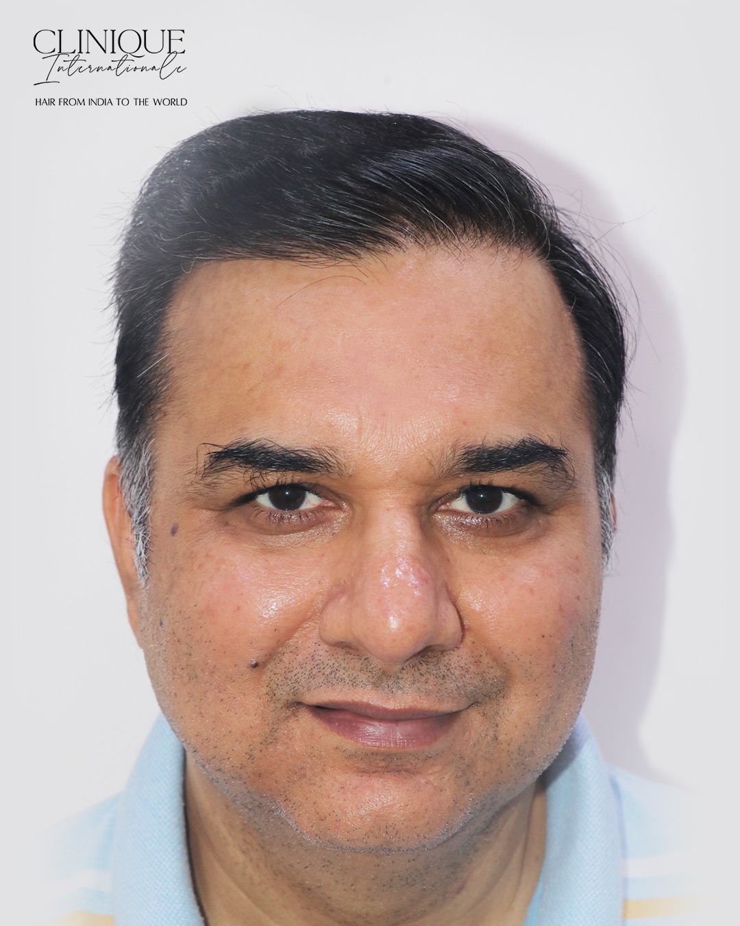 Karan after hair transplant