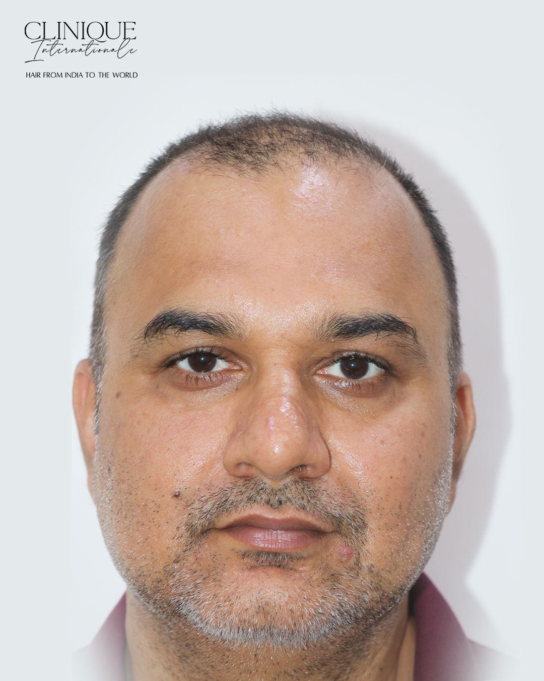Karan before hair transplant