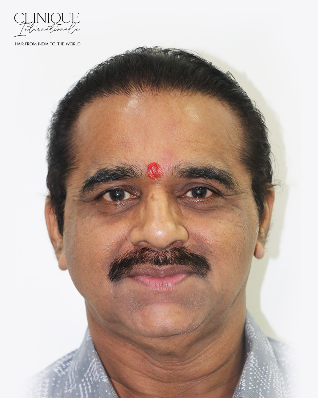 Patient after hair transplant