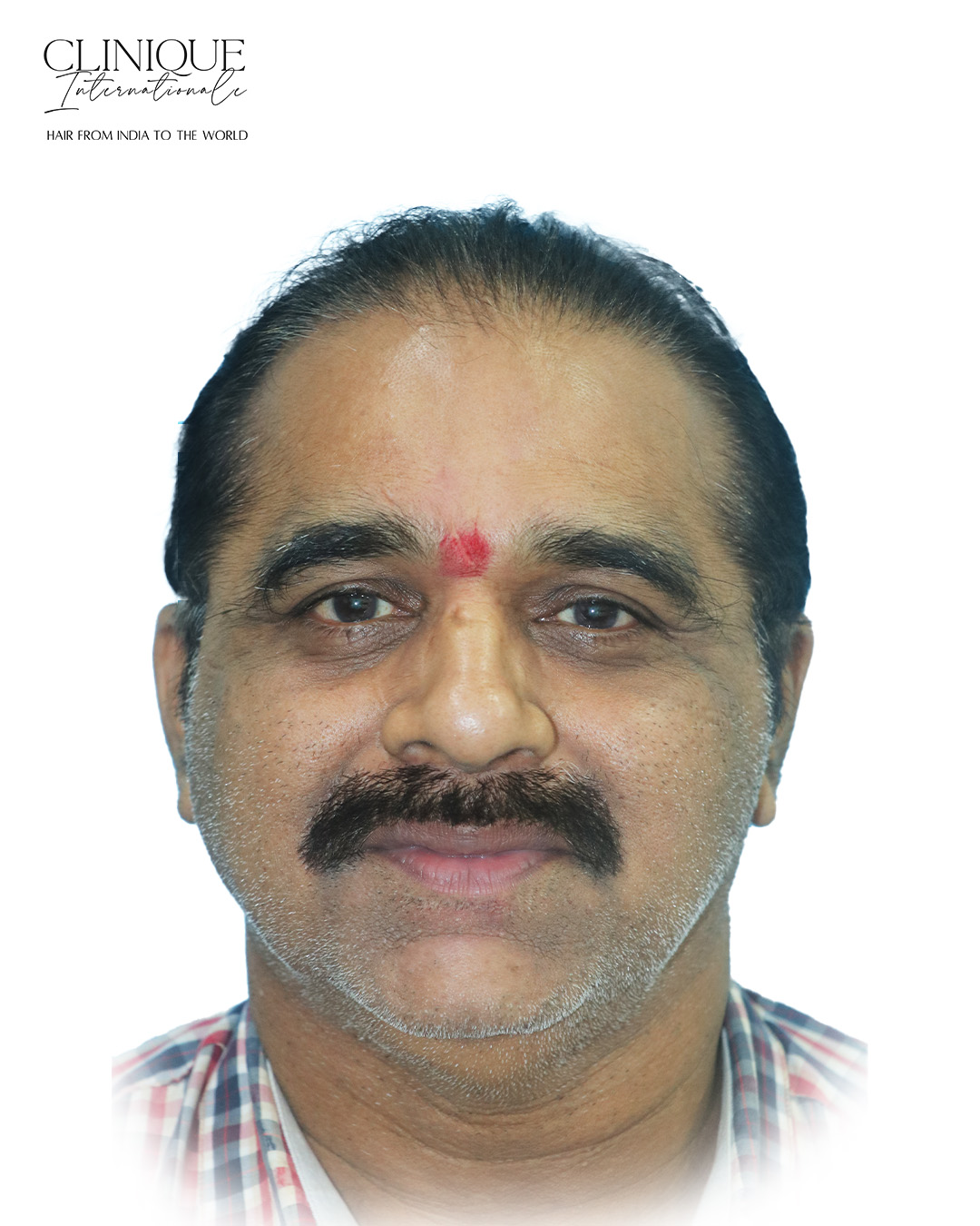 Patient before hair transplant